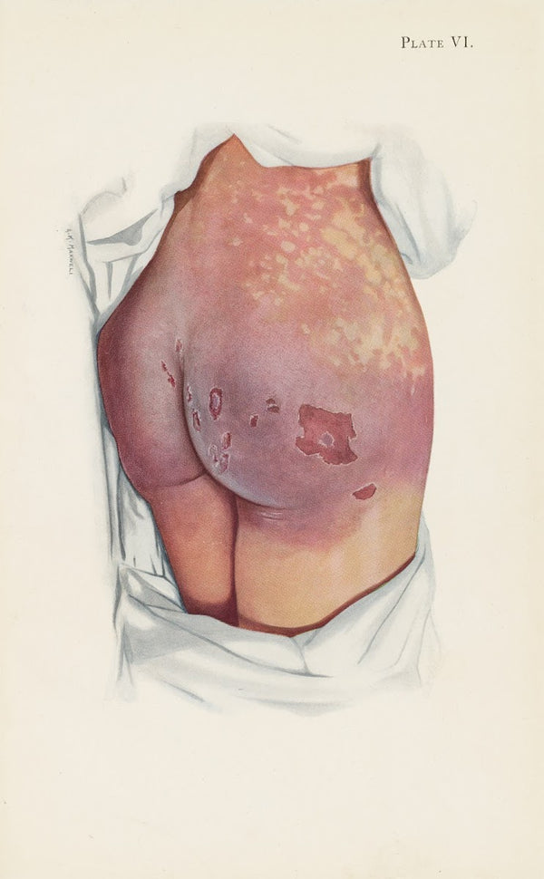 Plate VI Blistering of buttocks by mustard gas 1918