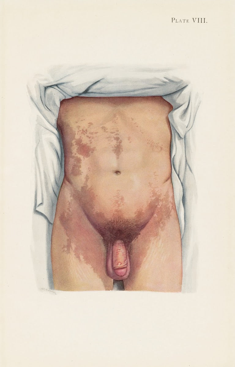 Plate VIII Brown staining from mustard gas 1918