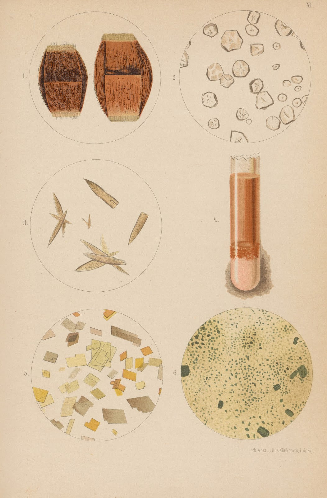 Uric Acid Crystals and Deposits 1899