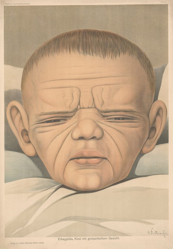Erbsyphilis Kind mit greisenhaftem Gesicht 1900
