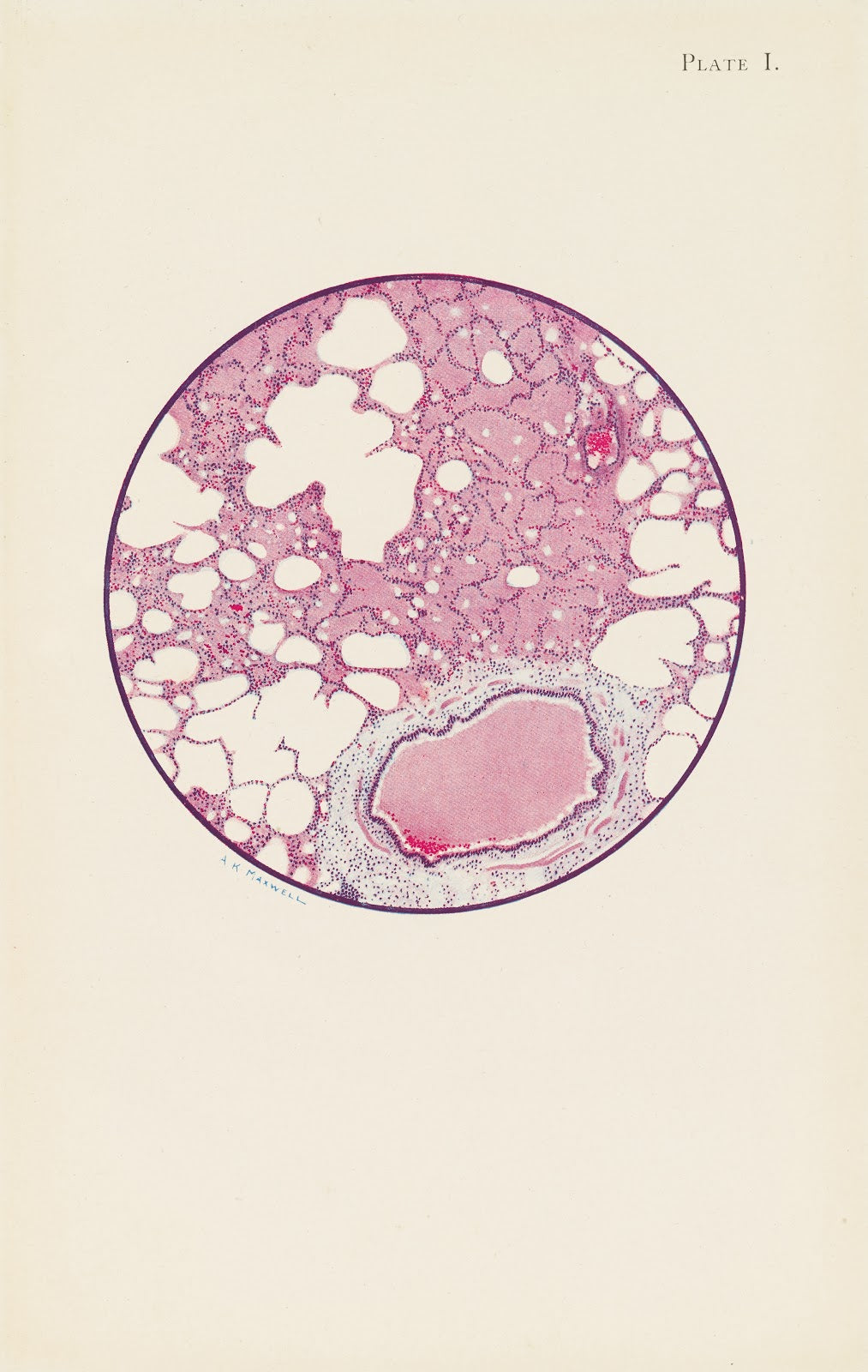 Plate I Microscopic section of human lung from phosgene shell poisoning Death at