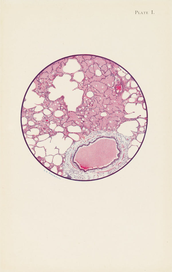 Plate I Microscopic section of human lung from phosgene shell poisoning Death at