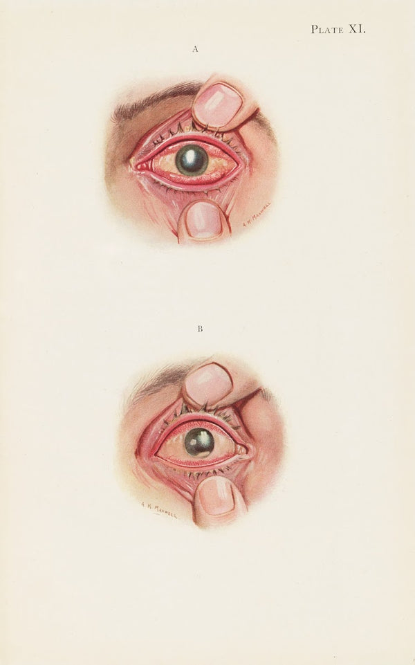 Plate XI A Severely burned eye in the acute stage B Slightly later stage of acut