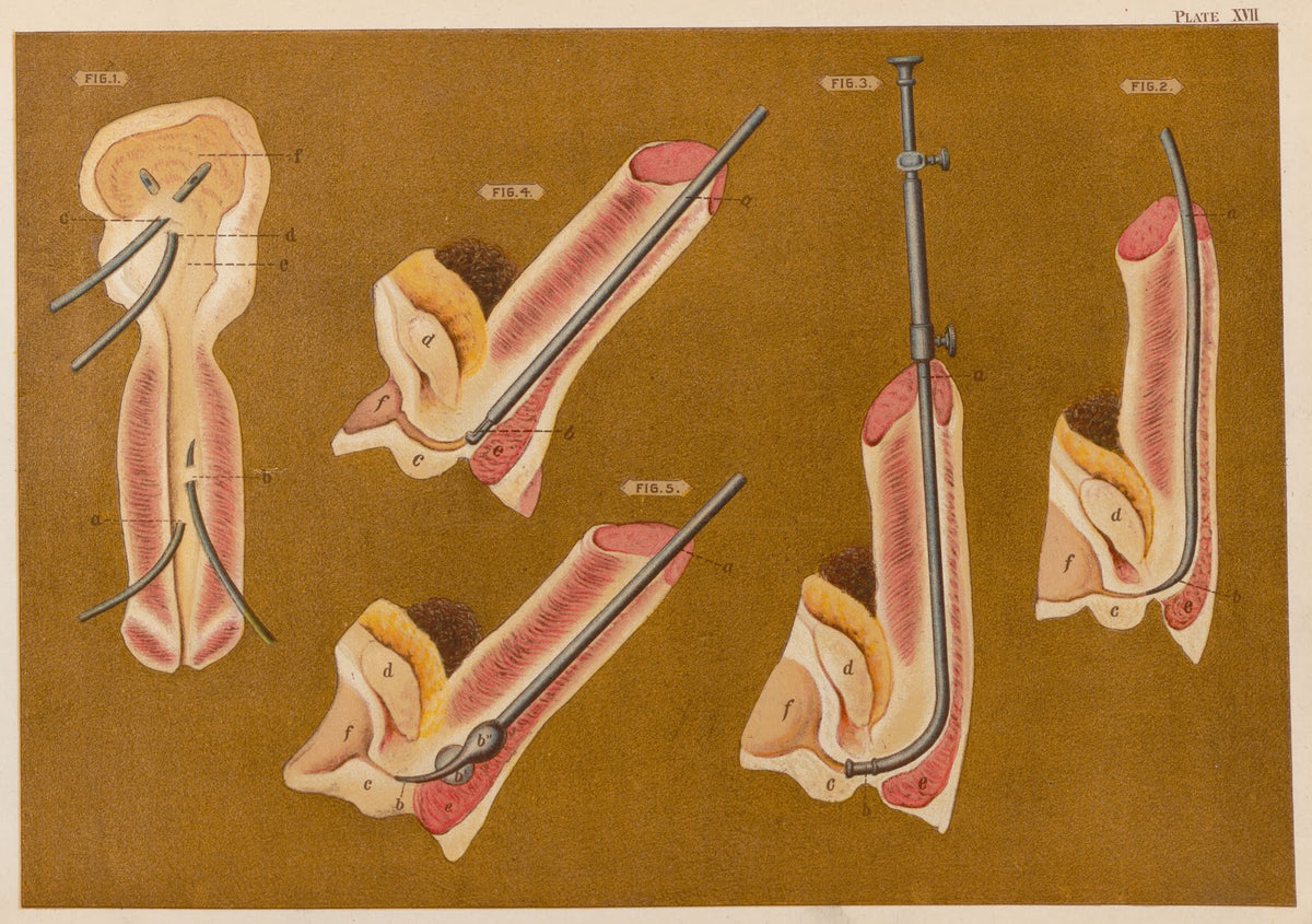 Operations upon the penis III 1889