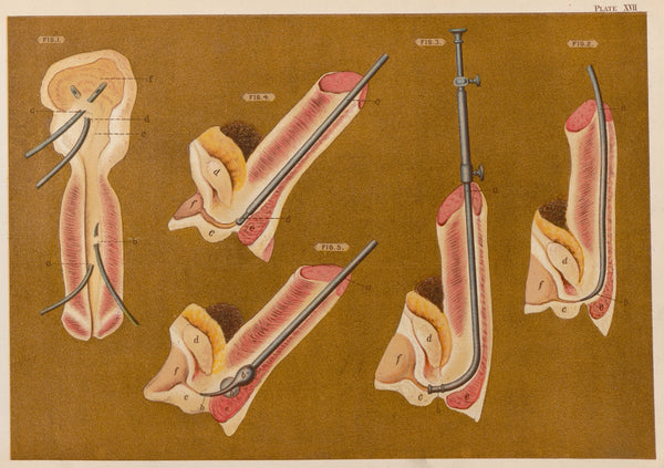 Operations upon the penis III 1889