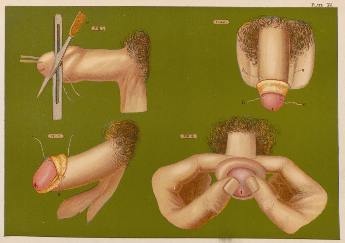 Operations upon the penis II 1889