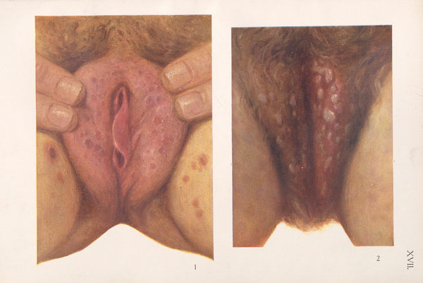 Venereal diseases  Syphilis Pl17 1908